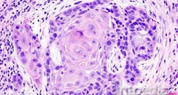 科研單位分析100名胃癌患者，驚訝地發現患胃癌的人，有5大共性